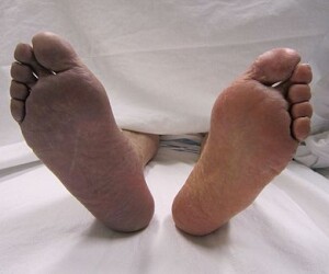 Trombosi arteriosa manifestatasi al piede destrto con cianosi